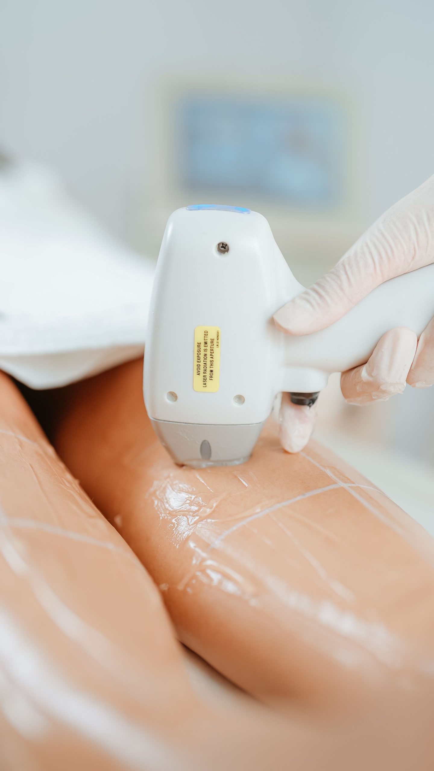 Close-up of a laser hair removal handpiece being used on the leg