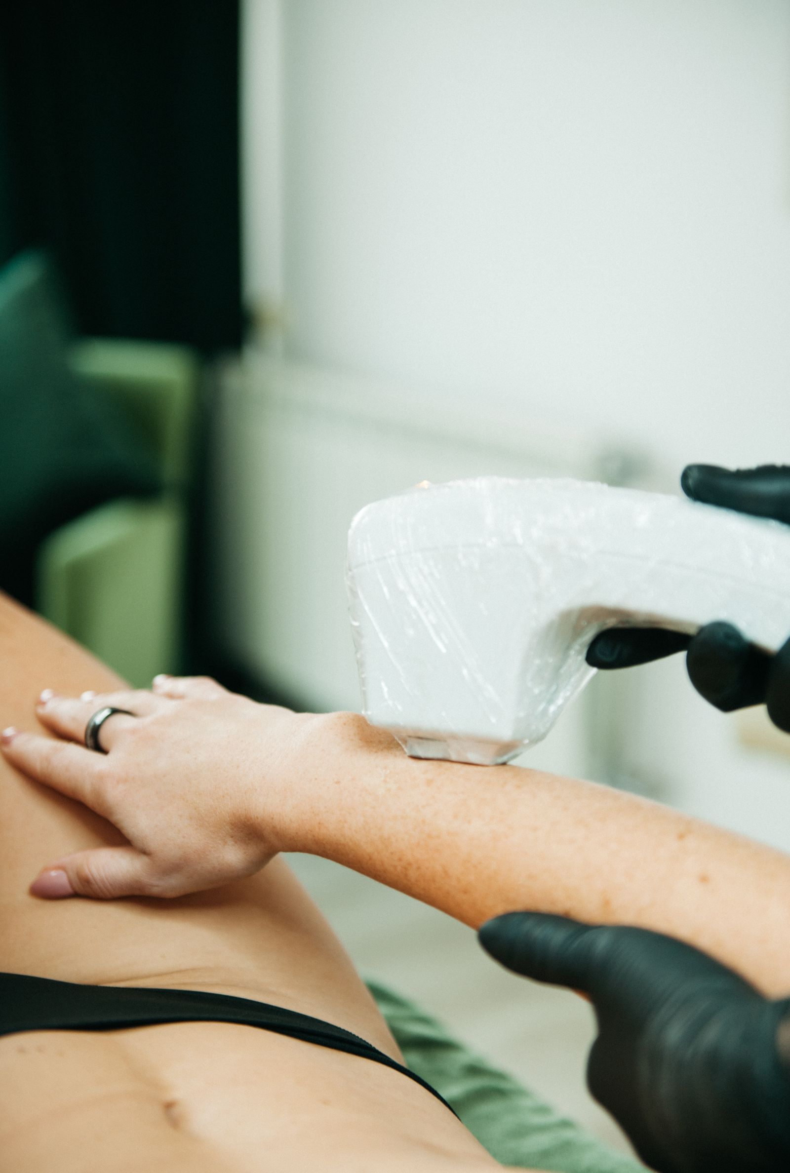 Close-up of laser hair removal being performed on an arm