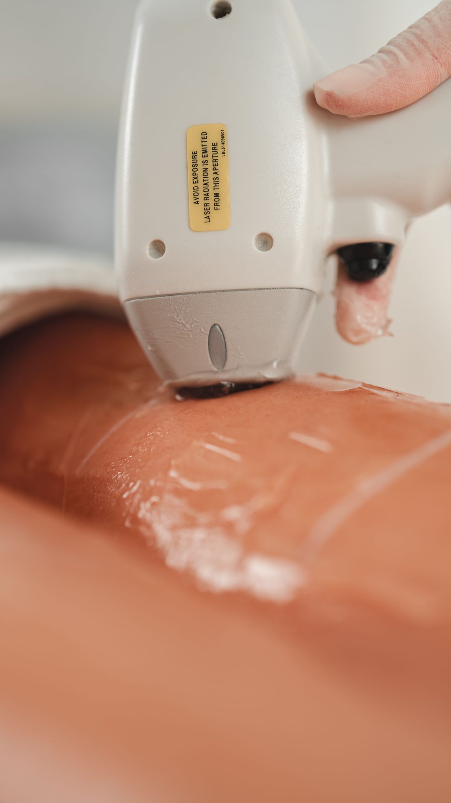 Laser hair removal handpiece and cooling gel during treatment